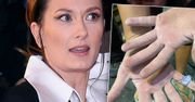 Anita Sokołowska pokazała poranione dłonie: „Czułam się jakby atakowała mnie grypa”. Boli od samego patrzenia