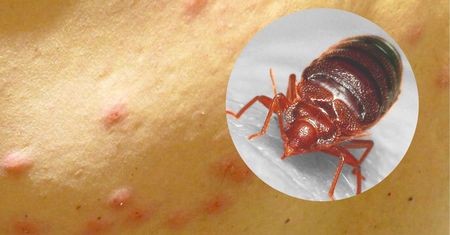 Jak rozpoznać ugryzienie pluskwy? Jest jedna cecha ich ukąszeń, która nie zostawia wątpliwości