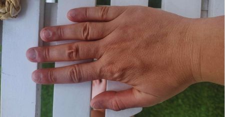 Zrób tę jedną czynność i sprawdź czy twoja skóra jest odwodniona. Tak robią lekarze