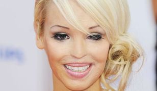 Katie Piper: wstrząsająca historia prezenterki poparzonej kwasem