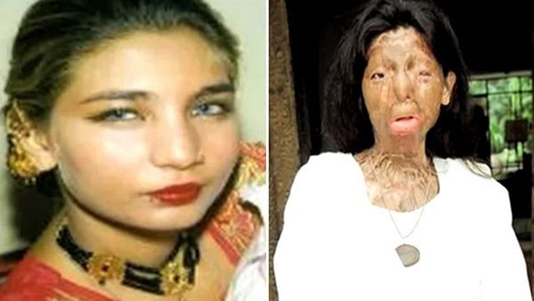 33-letnia Pakistanka oblana przez męża kwasem popełniła samobójstwo