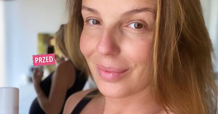 Agnieszka Włodarczyk po porodzie zafundowała sobie botoks. Zmiany widać jak na dłoni. W końcu odżyła