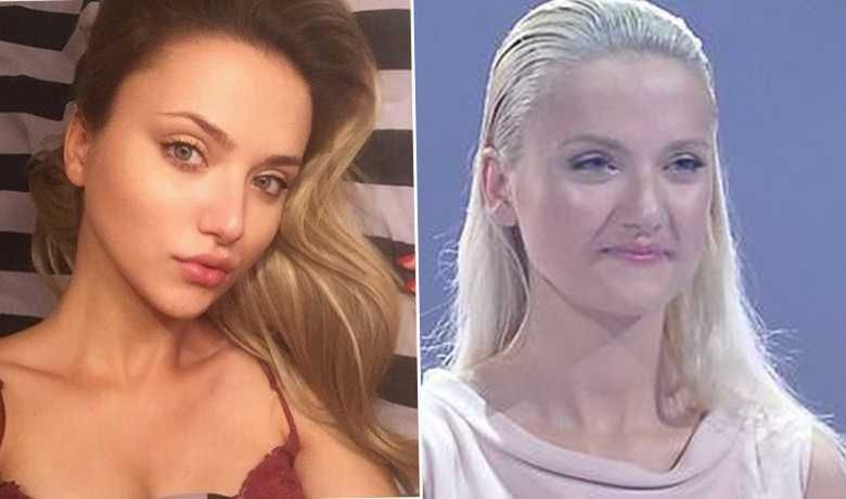 Marta Sędzicka - po i przed korektą ust