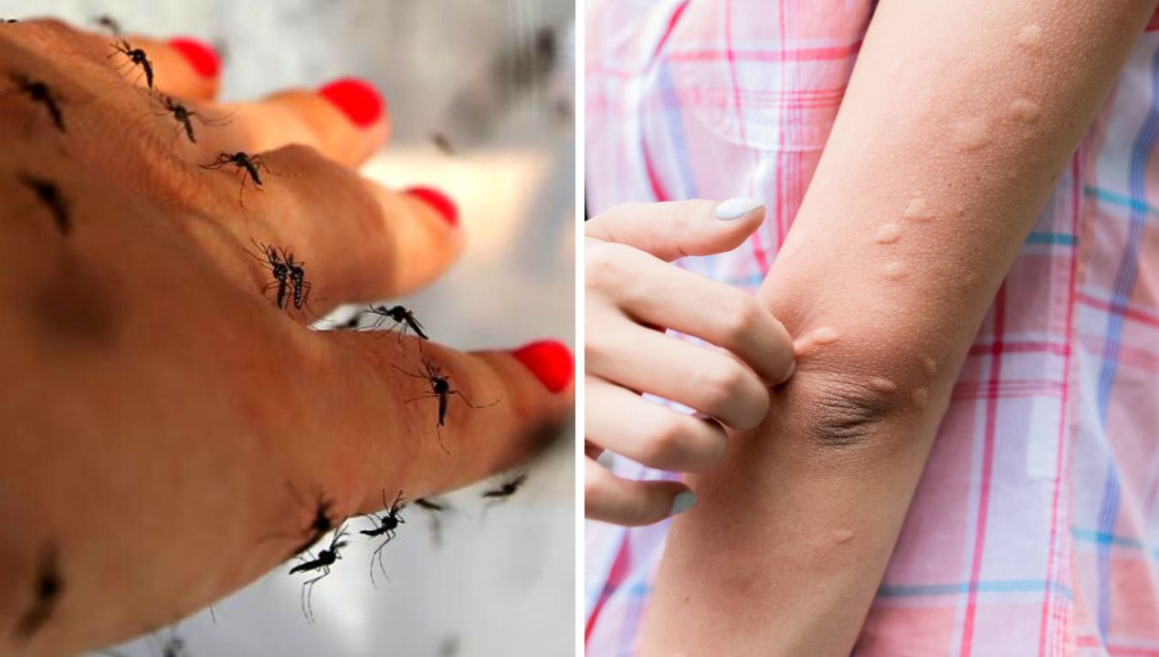 These Home Remedies for Mosquito Bites Really Work. You Will Get Rid of the Swelling Faster