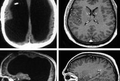 54-latek nie ma mózgu. Pracuje jako urzędnik