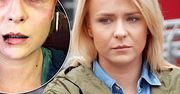 Aneta Zając brutalnie pobita! Pokazała przerażające zdjęcie posiniaczonej twarzy