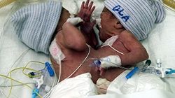 Patrycja i Ola - siostry syjamskie