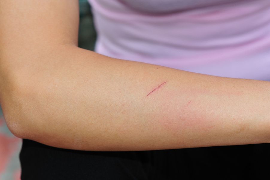 Pokrzywka alergiczna to najczęściej następstwo uczulenia np. na jakieś produkty żywnościowe, środki farmakologiczne.