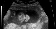 Zdjęcia płodu - twarze
