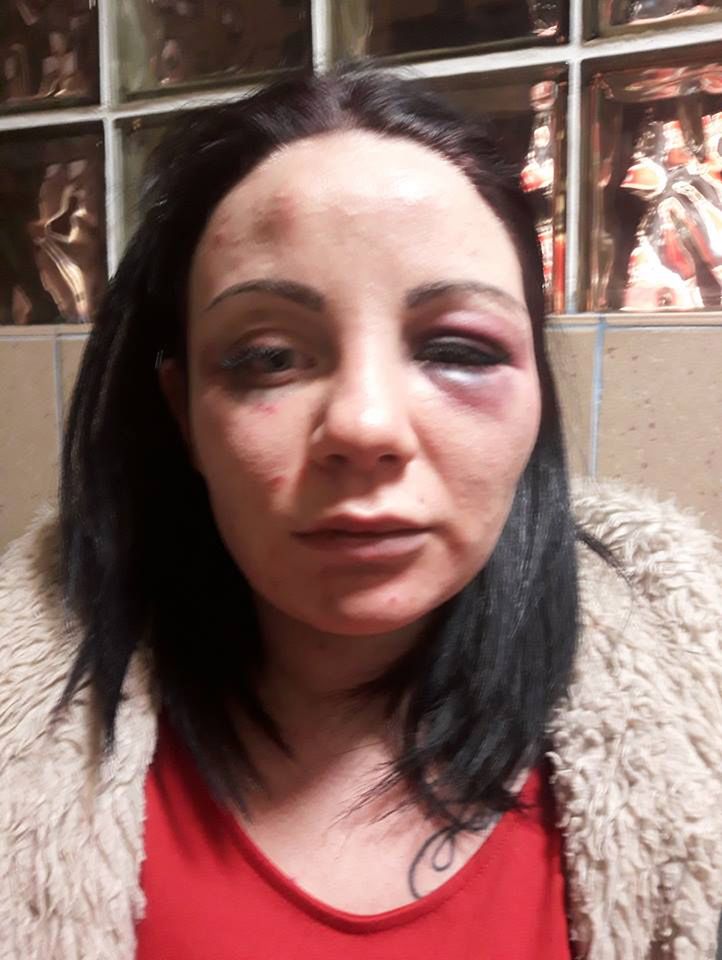 Martyna niedługo po pobiciu. (zakaz kopiowania zdjęć) 