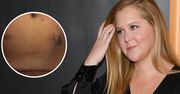 Amy Schumer poddaje się in vitro. Pokazała brzuch po zastrzykach