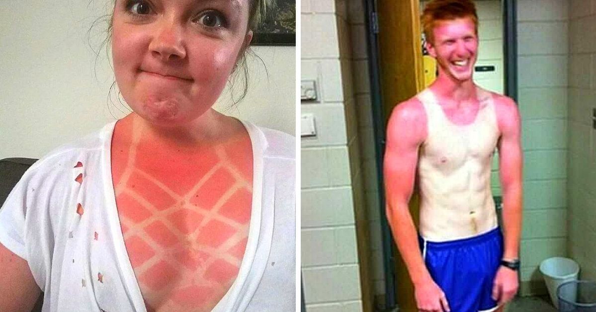 23 People Who Got Sunburned Rather Than Suntanned. Holidaymakers and Their 'Sunny' Adventures!