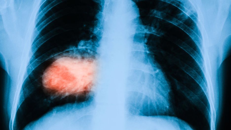 Pacjenci z nowotworem płuc nie skorzystają w nowoczesnego leczenia. 