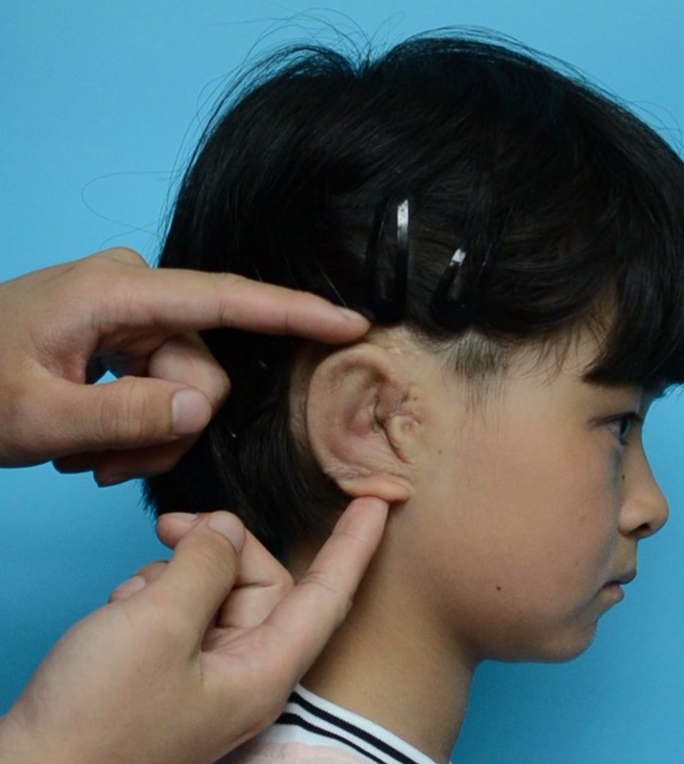 Naukowcy wyhodowali dzieciom nowe uszy. Wykorzystali drukarki 3D