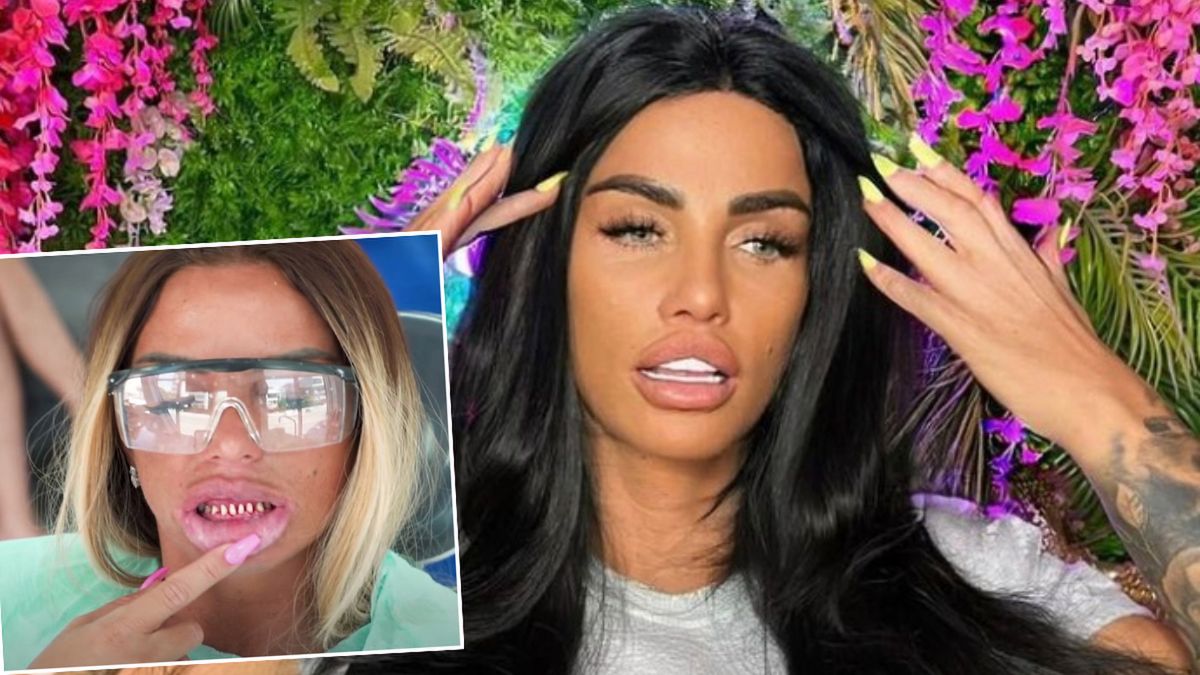 Katie Price wstawiła licówki w Turcji. Teraz wszystkie zęby jej odpadają!