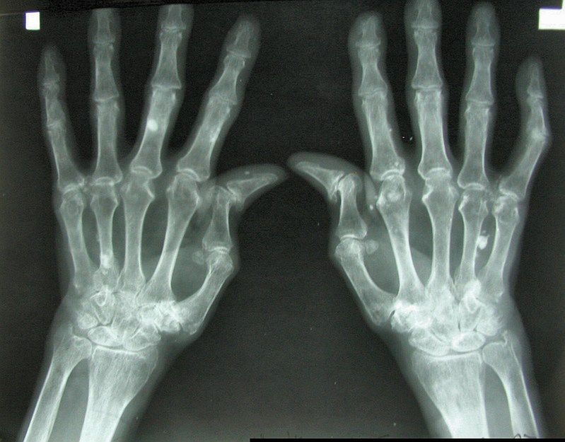Zdjęcie rentgenowskie dłoni 