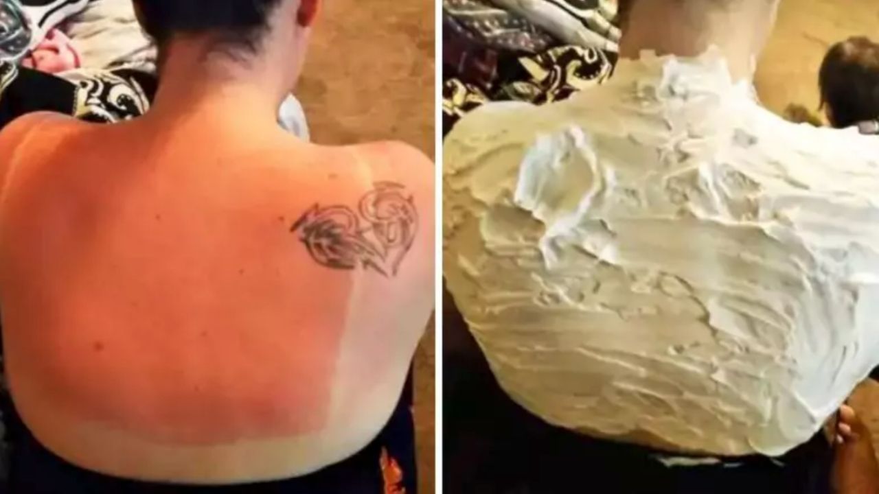 How to Alleviate a Sunburn? A Woman Discovered an Effective Way. In 15 Minutes the Pain Was Gone!