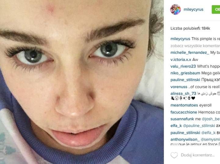 Miley Cyrus chwali się pryszczem