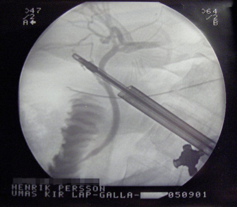 Obraz laparoskopii 