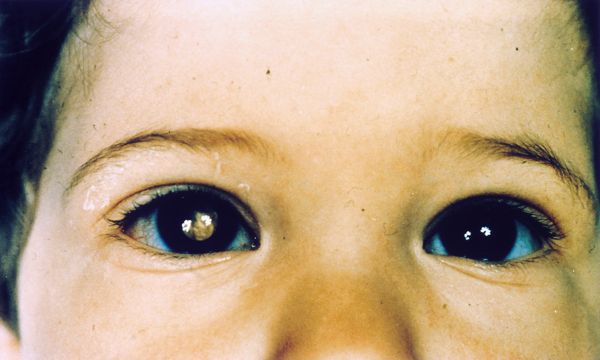 Siatkówczak widoczny na oku dziecka 