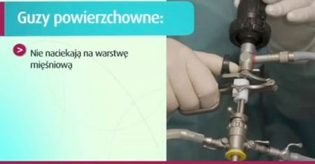 Leczenie raka pęcherza moczowego