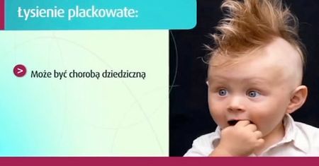 Genetyka w łysieniu plackowatym