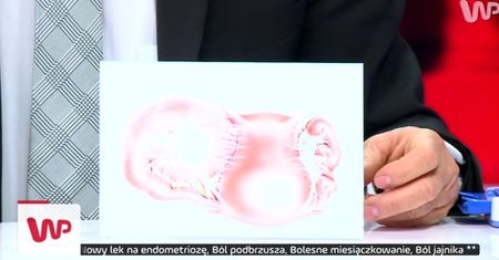 #dziejesienazywo: Endometrioza, a ciąża