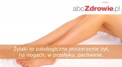 Fakty o zdrowiu - Czym są żylaki?