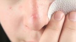 Domowe sposoby na trądzik - ziołowe parówki