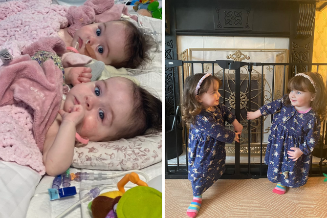 They twin sisters who have undergone the separation surgery