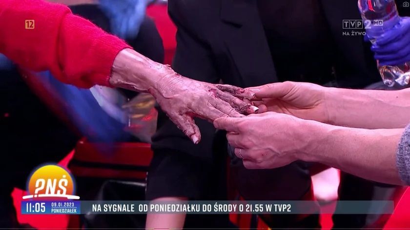 Ida Nowakowska z poparzoną dłonią w Pytaniu na śniadanie