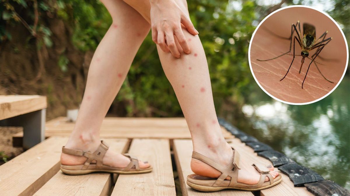 Ukąszenia komarów. Fot. AdobeStock
