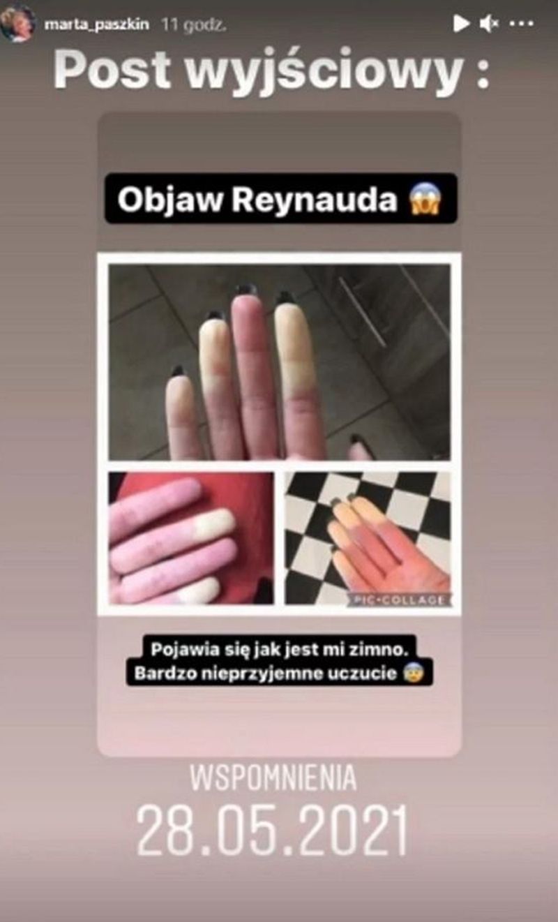 Marta Paszkin cierpi na objaw Raynauda