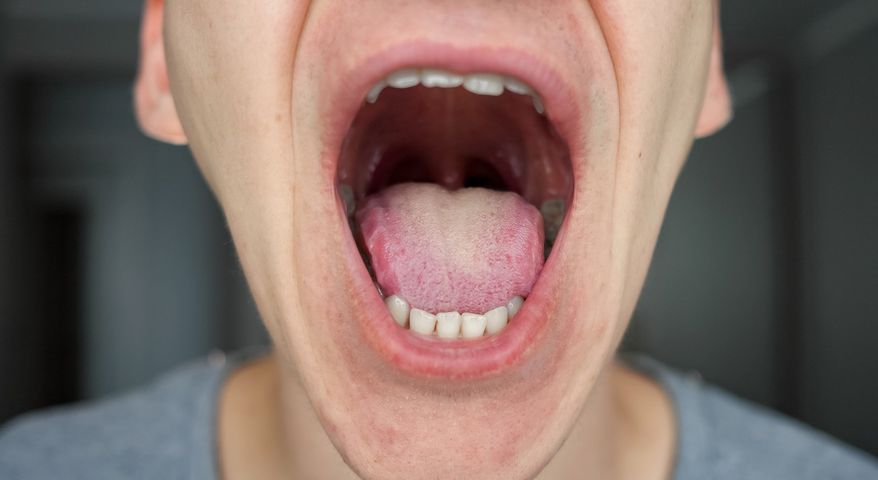 Bakteria jamy ustnej ma wpływ na wzrost komórek nowotworowych