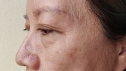 Podstępny przeciwnik. Objaw raka płuc można zauważyć na twarzy