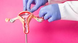Podwiązanie jajowodów - na czym polega, skuteczność, skutki uboczne