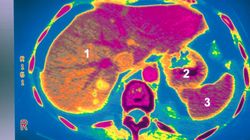 Koronawirus. Coraz więcej pacjentów z uszkodzoną wątrobą po COVID-19. W USA mają duży problem