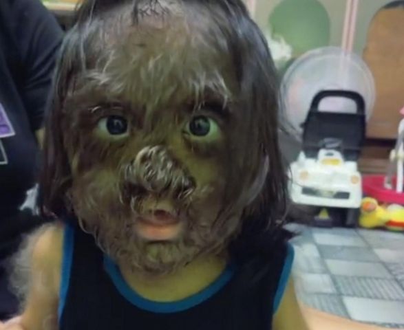 TikTokerka nagrywa filmy z dzieckiem, które cierpi na syndrom wilkołaka