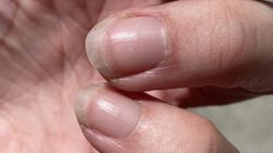 Zwiastuje marskość wątroby. Ponad 80 proc. chorych ma ten objaw