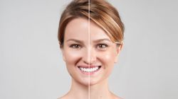 Thermo-lifting twarzy RF - wskazania do zabiegu