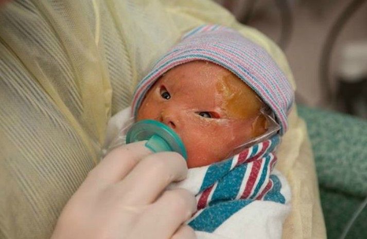 Brenna - noworodek arlekin
