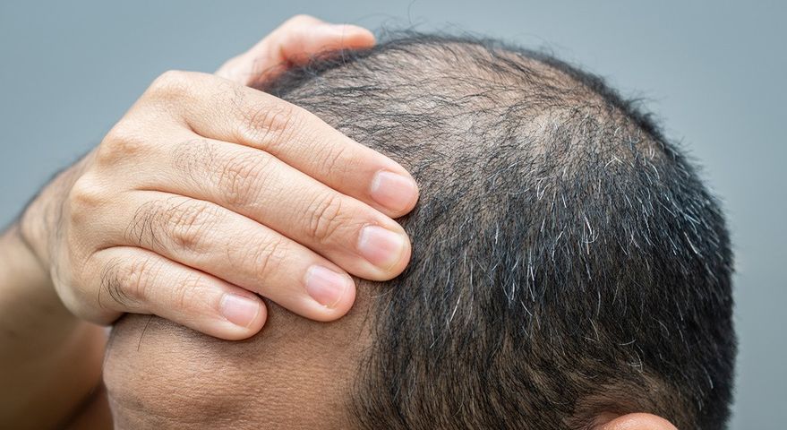 Wypadanie włosów może być objawem choroby