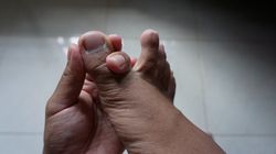 Objaw raka płuc możesz zauważyć na stopach. Nigdy nie lekceważ