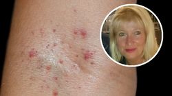 Wczesny objaw raka krwi. Lekarka ostrzega przed często popełnianym błędem