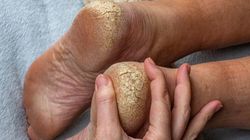 Poważny niedobór. Główny objaw zauważysz na piętach