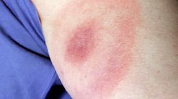 Charakterystyczne znamię. Pojawia się, gdy trzustka potrzebuje natychmiastowej pomocy