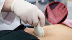 Dłonie zdradzają, że wątroba nie daje rady. Niepozorny objaw