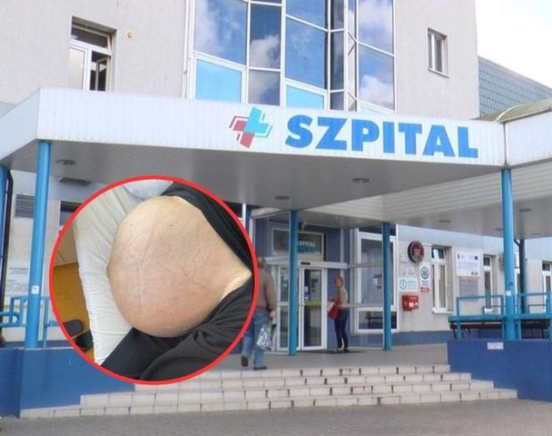 Kobieta z gigantycznym guzem jajnika trafiła do szpitala. W jej ciele rósł od ponad roku