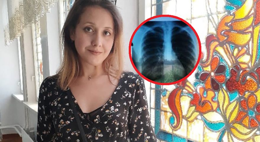 Olesya Kulikova ma rzadką chorobę, jej narządy są położone inaczej niż powinny