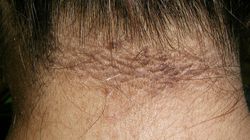 Lekarz pokazuje widoczny objaw cukrzycy. Charakterystyczny sygnał może pojawić się na szyi